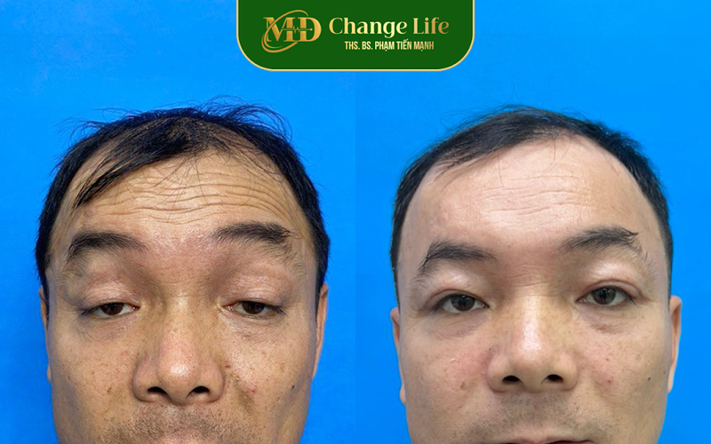 Chỉnh hình sụp mí tại Thẩm mỹ MD Change Life (Nguồn: MD Change Life)
