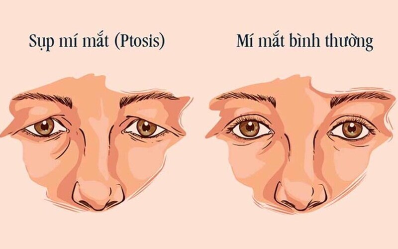 Tình trạng mắt sụp mí ( Nguồn: Internet )