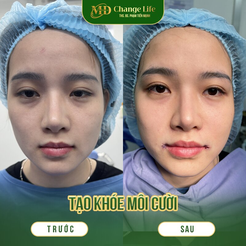 Bạn có thể tham khảo liệu trình này tại Thẩm mỹ MD Change Life (Nguồn: MD Change Life)
