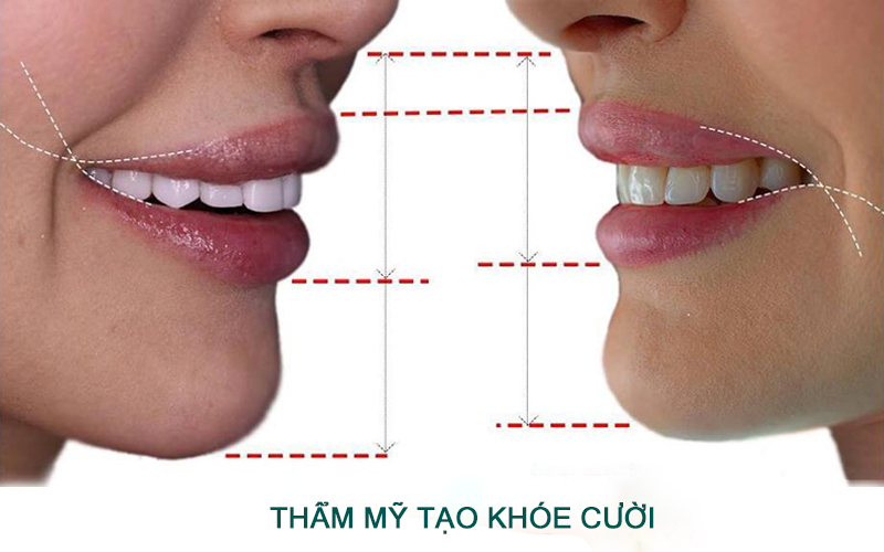 Top 5 địa chỉ tạo khóe môi cười tại Nghệ An