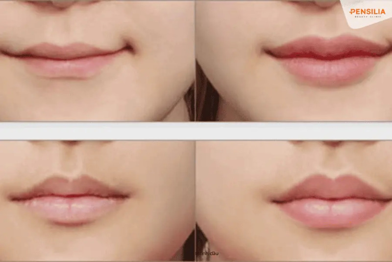 Dịch vụ tạo khóe môi cười tại Pensilia Beauty Clinic (Nguồn: Internet)