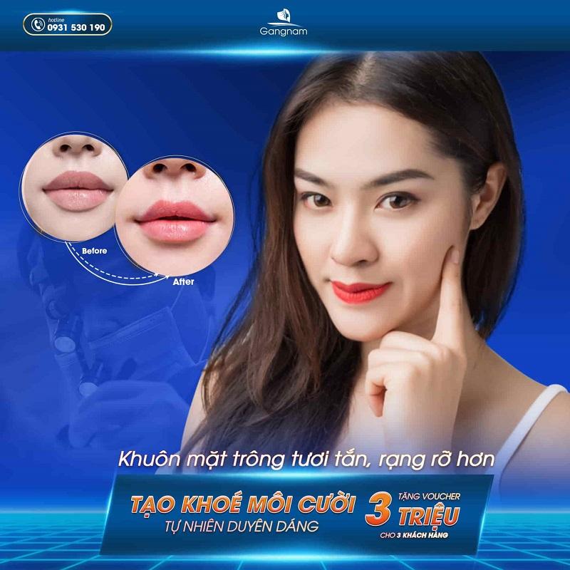 Dịch vụ tạo khóe môi cười tại Bệnh viện Thẩm mỹ Gangnam (Nguồn: Internet)