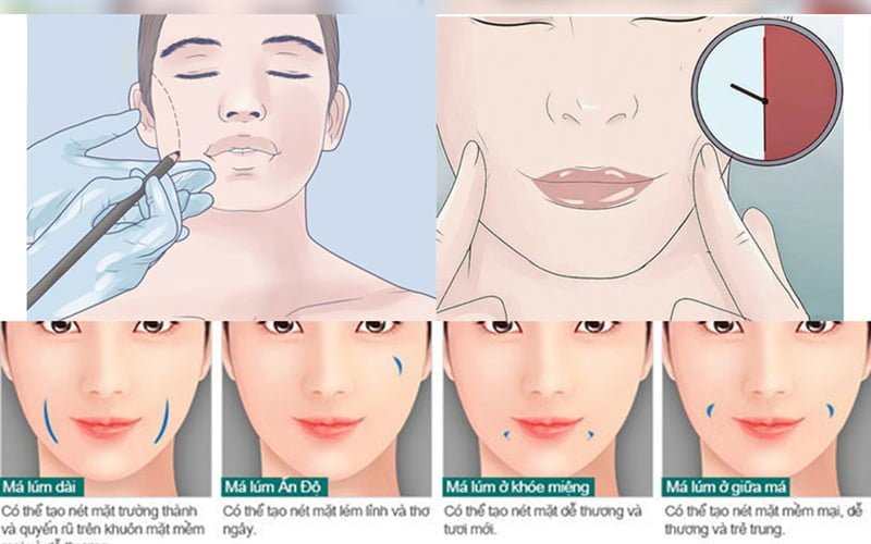 Tạo má lúm đồng  có đau không (Nguồn: Internet)
