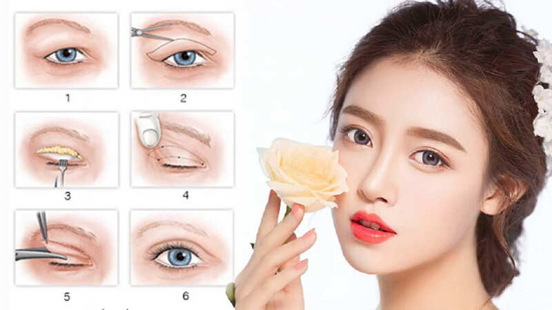 Tạo mắt 2 mí bằng phương pháp cắt mí (Nguồn: Internet)