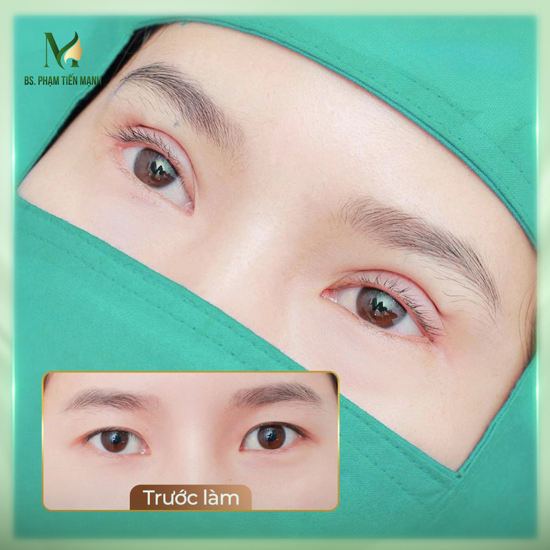 MD Change Life đứng đầu về dịch vụ tạo mắt 2 mí Hà Nội (Nguồn:MD Change Life)