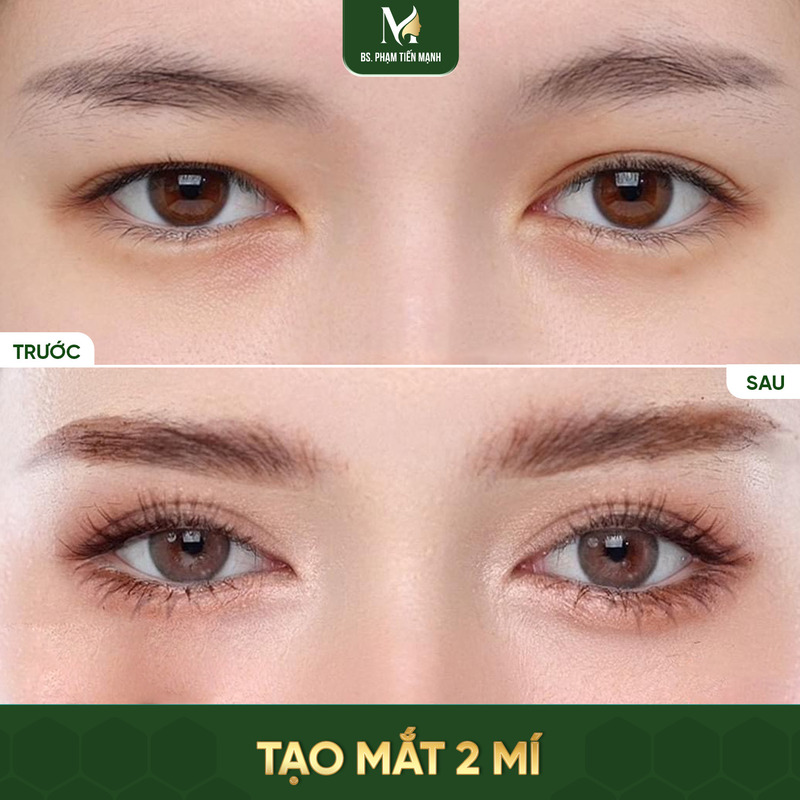 Kết quả sau khi tạo mắt 2 mí tại Thẩm Mỹ MD Change Life (Nguồn: Thẩm Mỹ MD Change Life)