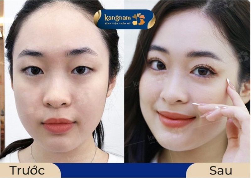 Dịch vụ tạo mắt 2 mí Nghệ An tại Bệnh viện Thẩm mỹ Kangnam (Nguồn: Bệnh viện Thẩm mỹ Kangnam)