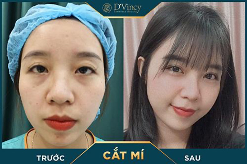 Tạo mắt 2 mí tại Thẩm mỹ Quốc tế D’Vincy (Nguồn: Thẩm mỹ Quốc tế D’Vincy)