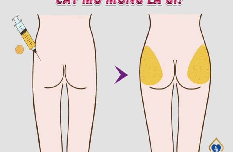 Sau khi nâng mông bạn thấy không hợp với dáng người (Nguồn: Internet)