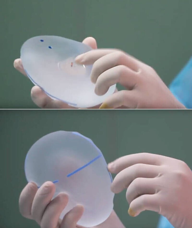 Tiến hành phẫu thuật để tháo túi độn (Nguồn: Internet)