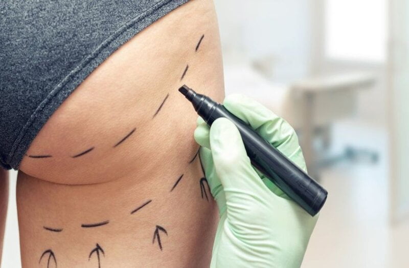 Phẫu thuật không nội soi là phương pháp phổ biến hơn (Nguồn: Internet)