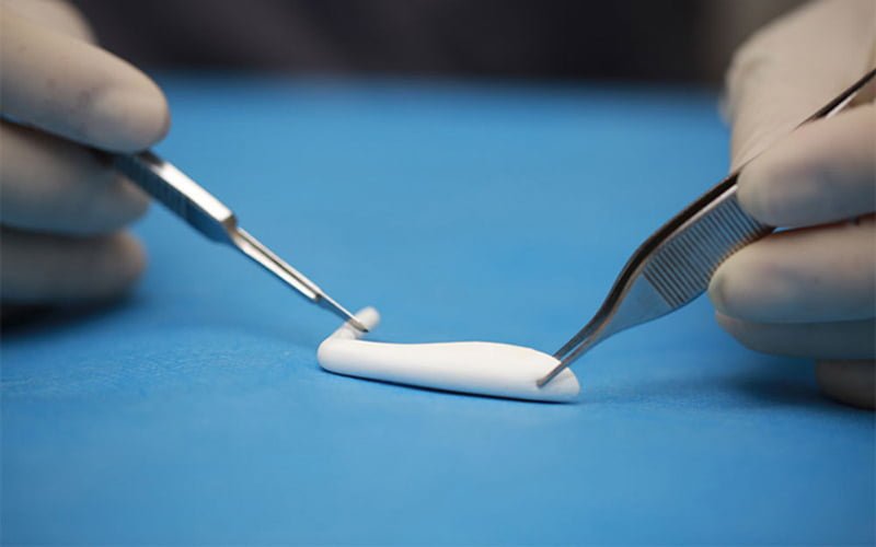 Tháo chất liệu mũi là kỹ thuật y khoa tiên tiến nhằm loại bỏ sụn mũi (Nguồn: Internet)