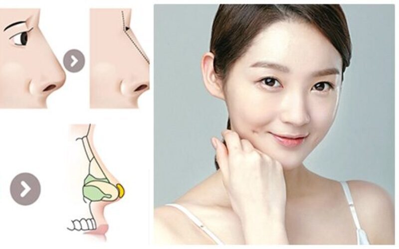 Dấu hiệu nhận biết cần tháo chất liệu mũi (Nguồn: Internet)