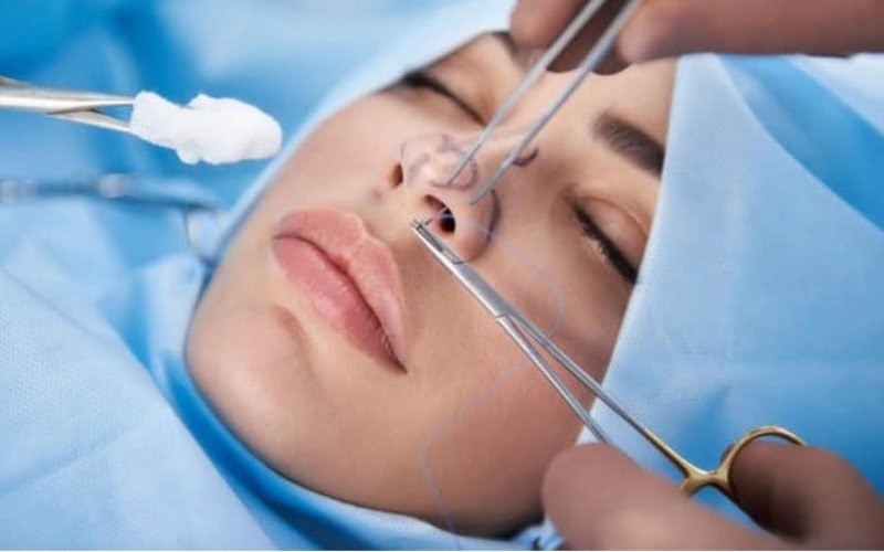 Tháo chất liệu mũi là một phẫu thuật thẩm mỹ đòi hỏi tay nghề cao và kinh nghiệm dày dặn của bác sĩ (Nguồn: Internet)