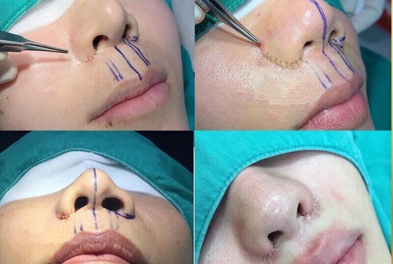 Quy trình thu gọn cánh mũi (Nguồn: Internet)