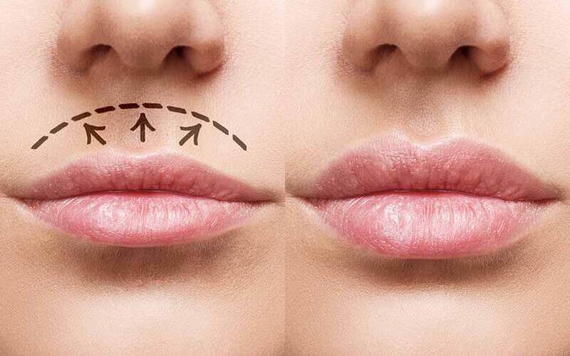 Thu ngắn nhân trung (Nguồn: Internet)