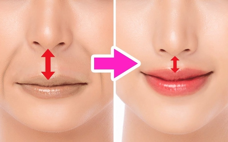 Phẫu thuật thu ngắn nhân trung (Nguồn: Internet)