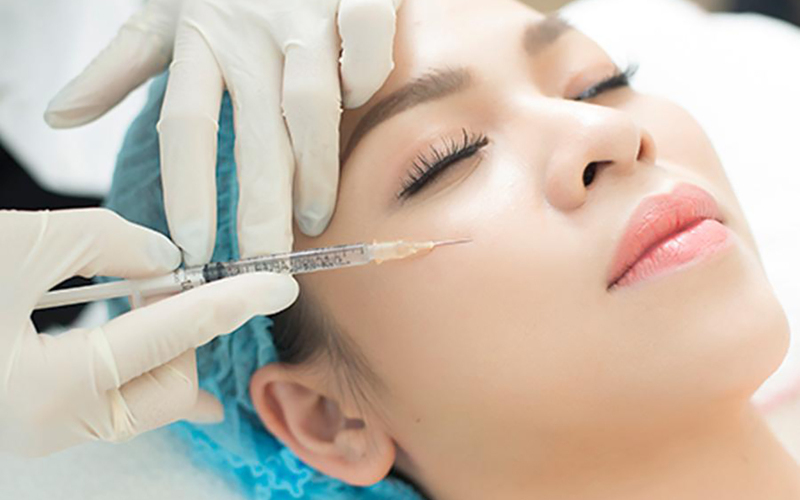 Tiêm filler thu ngắn nhân trung (Nguồn: Internet)
