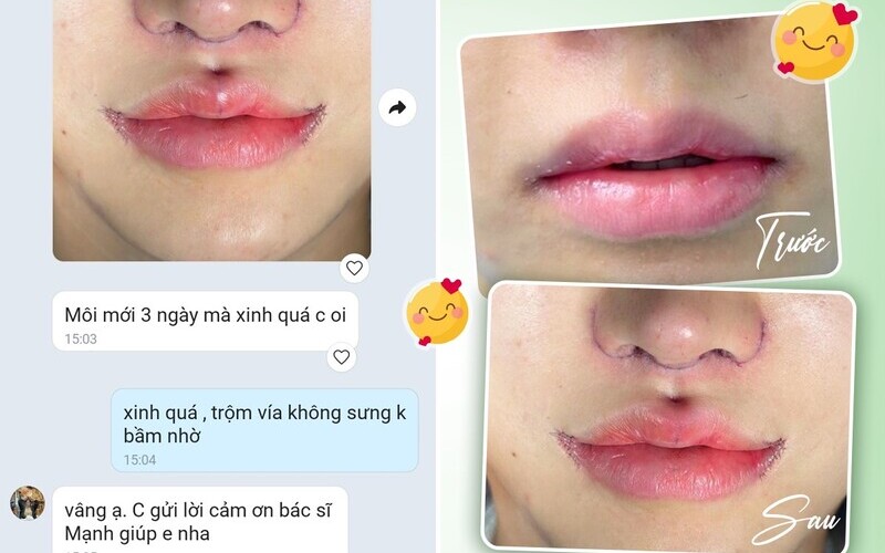 Feedback khách hàng sau thu ngắn nhân trung (Nguồn: MD Change Life)