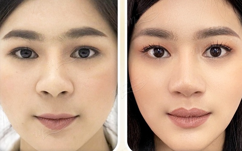 Top 5 địa chỉ thu ngắn nhân trung tại Nghệ An