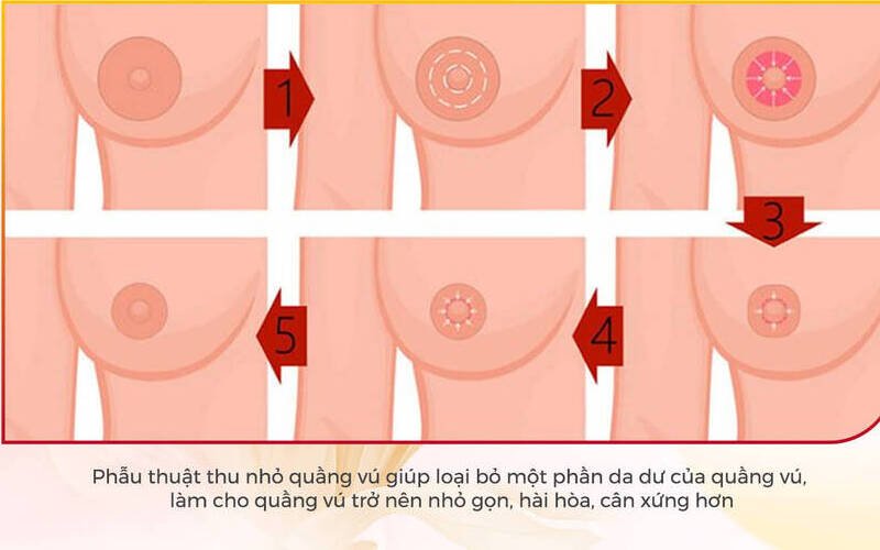 Thu quầng ngực (Nguồn: Internet)