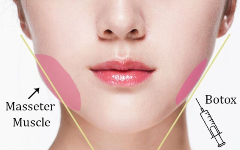 Tiêm botox góc hàm (Nguồn: Internet)