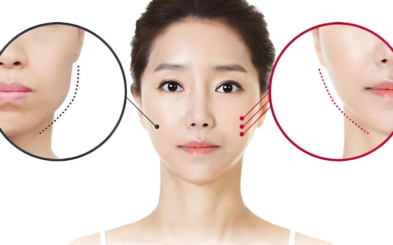 Tiêm botox gọn hàm (Nguồn: Internet)