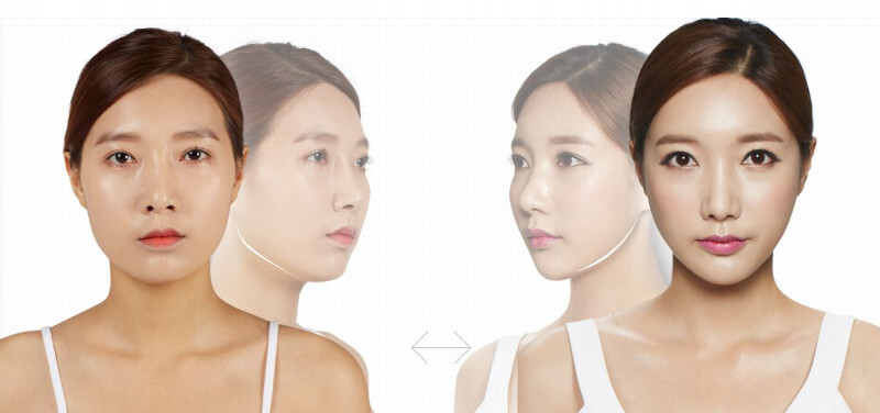 Người có góc hàm to và thô có thể dùng Botox để làm mềm đường nét và thon gọn khuôn mặt đáng kể (Nguồn: Internet)