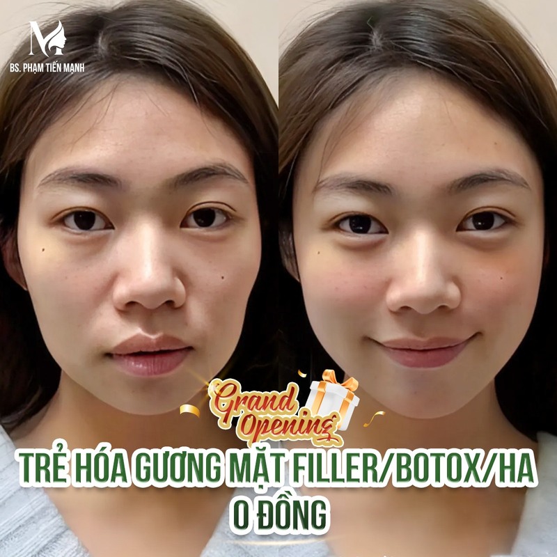 Thẩm mỹ MD Change Life – Địa chỉ vàng cho dịch vụ tiêm Botox gọn hàm uy tín (Nguồn: MD Change Life)