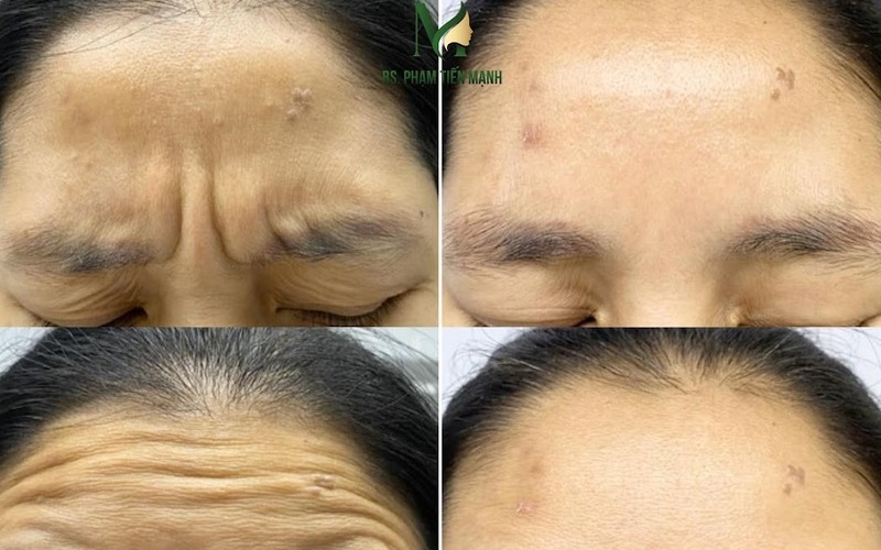 Kết quả tiêm cau mày tại Thẩm mỹ MD Change Life (Nguồn: MD Change Life)