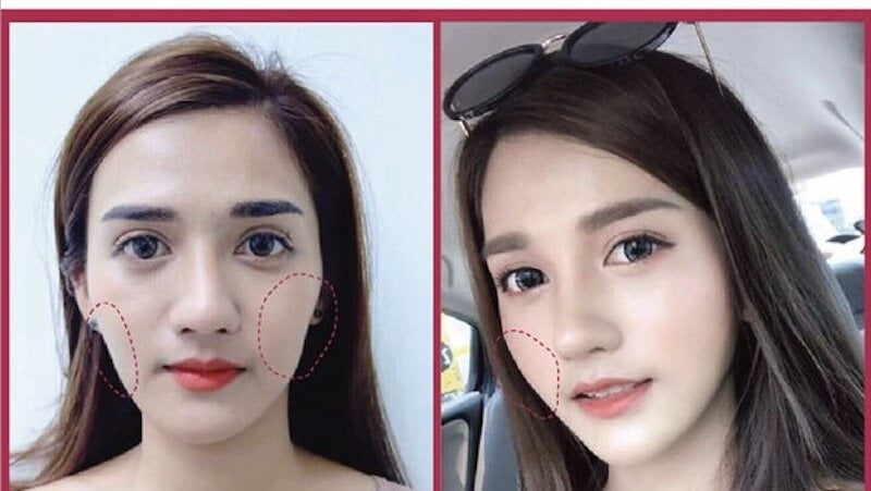 Tiêm filler phồng má baby hot trend 2024 (Nguồn: Internet)