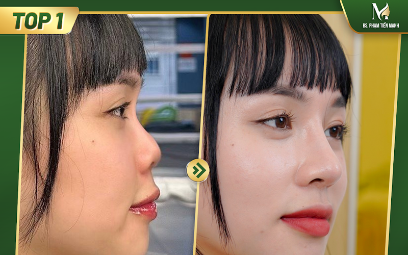 Tiêm Filler Mũi Bị Hoại Tử: Nguy Hiểm Rình Rập & Cách Bảo Vệ Bản Thân