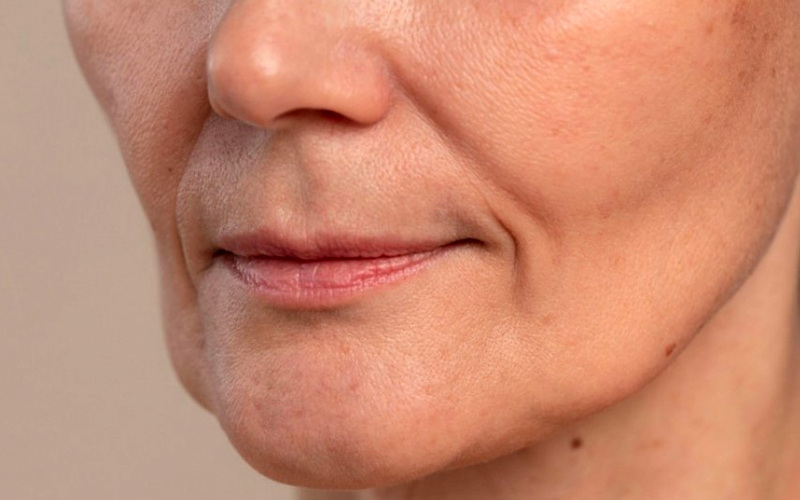 Người có rãnh cười sâu cần tiêm khoé cười (Nguồn: Internet)