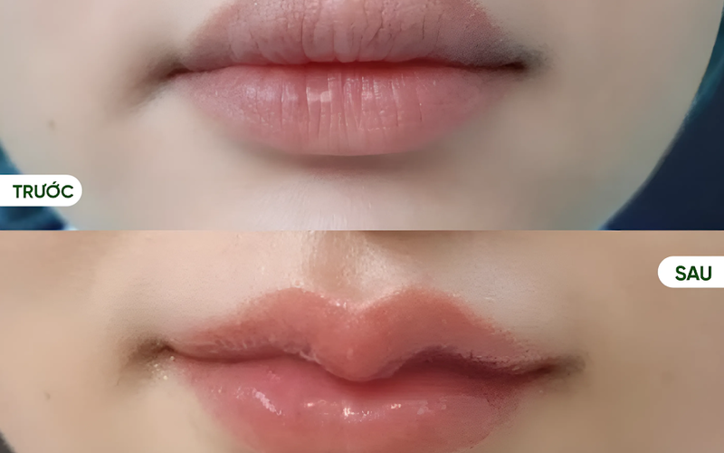 Tiêm filler tạo khoé môi cười (Nguồn: MD Change Life)