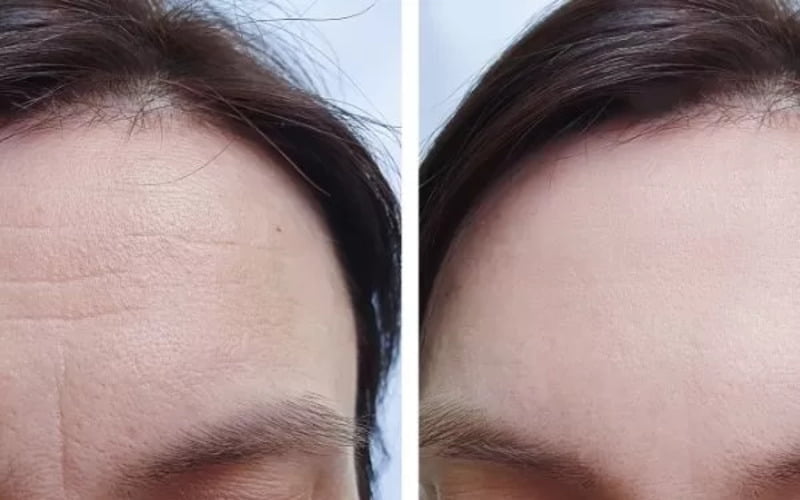 Quy trình tiêm xóa nhăn trán (Nguồn: Internet)