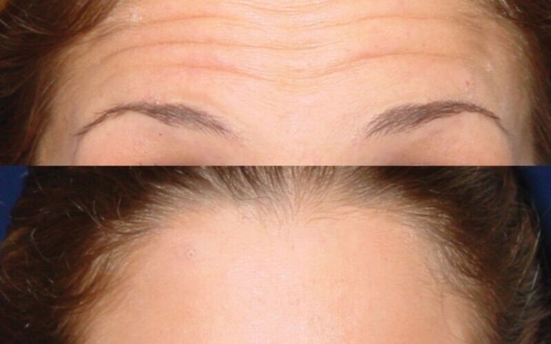 Lưu ý một số điều quan trọng để đảm bảo hiệu quả tốt nhất và an toàn sau khi tiêm xóa nếp nhăn trán (Nguồn: Internet)