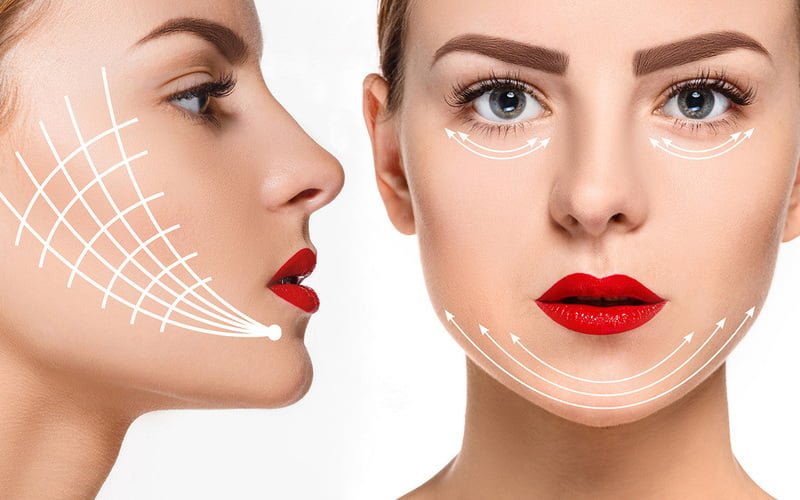 Căng chỉ nâng cơ mặt (Nguồn: Internet)