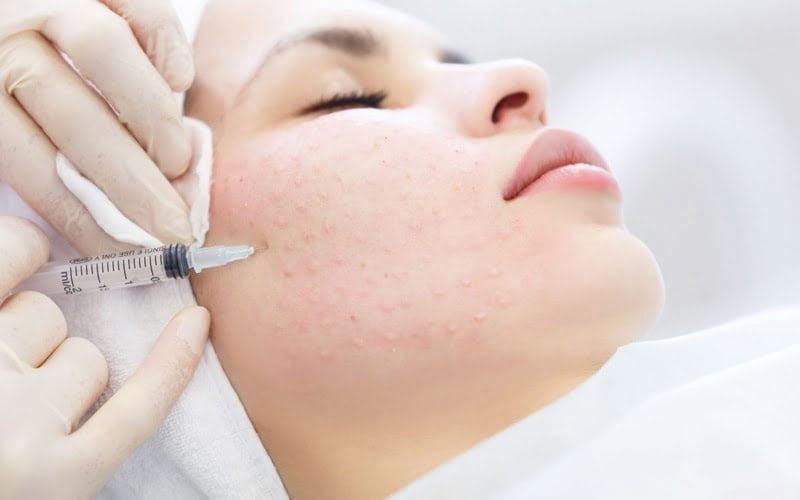 Tiêm meso trẻ hóa da (Nguồn: Internet)