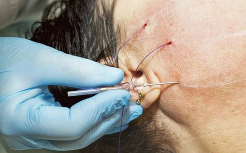 Căng da mặt (Nguồn: Internet)