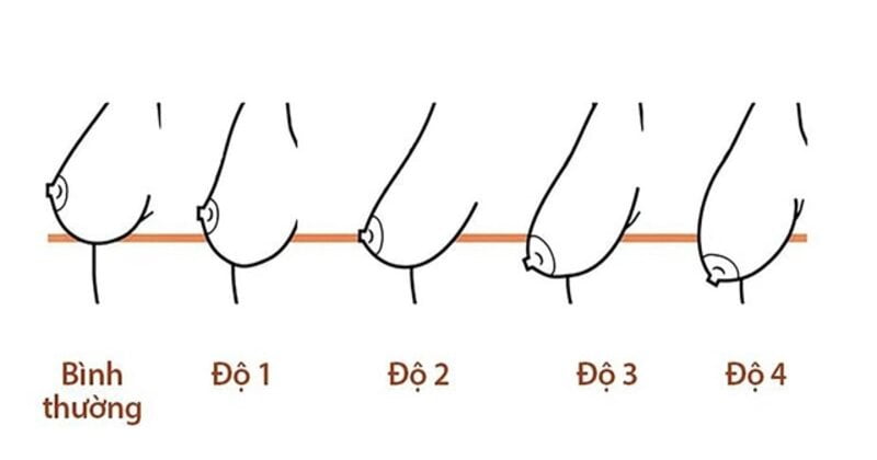 Treo sa trễ là gì? Các cấp độ treo sa trễ (Nguồn: Internet)