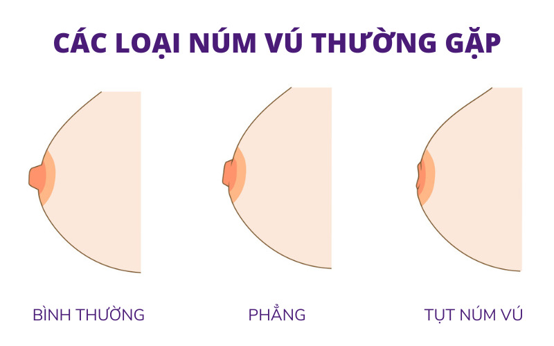 Tụt núm vú: Nguyên nhân và 3 cách khắc phục hiệu quả