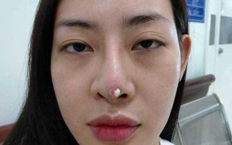 Tụt sụn đầu mũi: Nguyên nhân, dấu hiệu và cách khắc phục hiệu quả