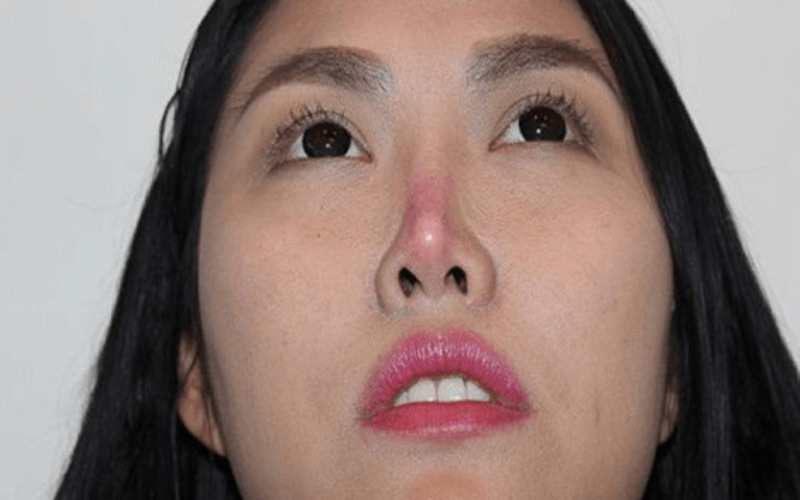 Tụt sụn đầu mũi: Nguyên nhân, dấu hiệu và cách khắc phục hiệu quả