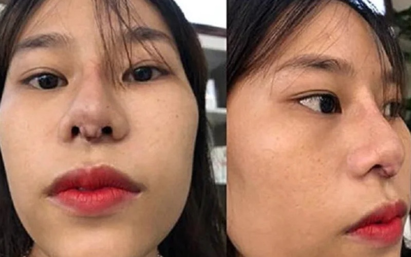 Tụt sụn đầu mũi: Nguyên nhân, dấu hiệu và cách khắc phục hiệu quả