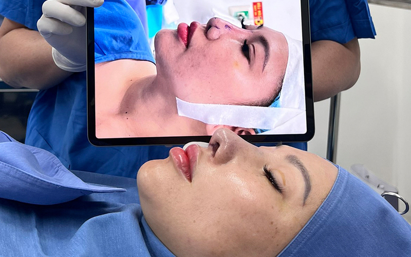 Tụt sụn đầu mũi: Nguyên nhân, dấu hiệu và cách khắc phục hiệu quả