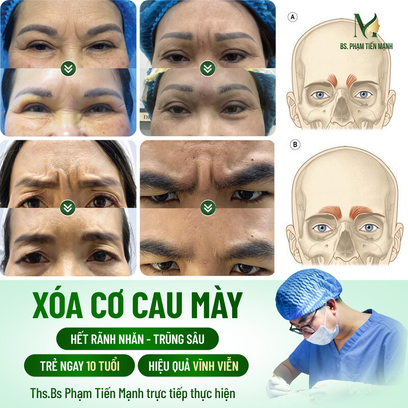 Xóa cơ cau mày – Giải pháp trẻ hóa gương mặt tối ưu tại Thẩm Mỹ MD Change Life (Nguồn: MD Change Life)