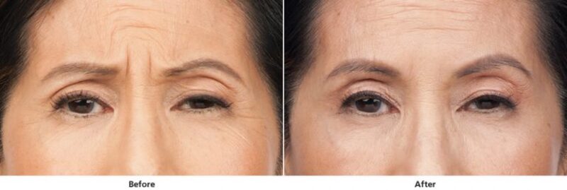 Hình ảnh da sau khi thực hiện xóa vết cau mày (Nguồn: Internet)