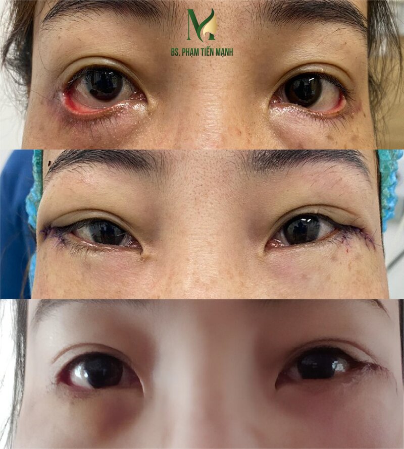 Thẩm mỹ MD Change Life- Địa điểm xoá rãnh lệ uy tín hàng đầu Nghệ An (Nguồn: MD Change Life)