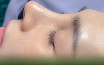 Mũi đẹp nhờ ThS BS Mạnh - bác sĩ nâng mũi giỏi ở Hà Nội (Nguồn: MD Change Life)