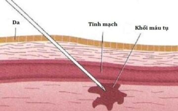 10 biến chứng phẫu thuật thẩm mỹ